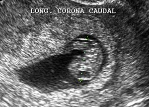 Longitud Corona Caudal